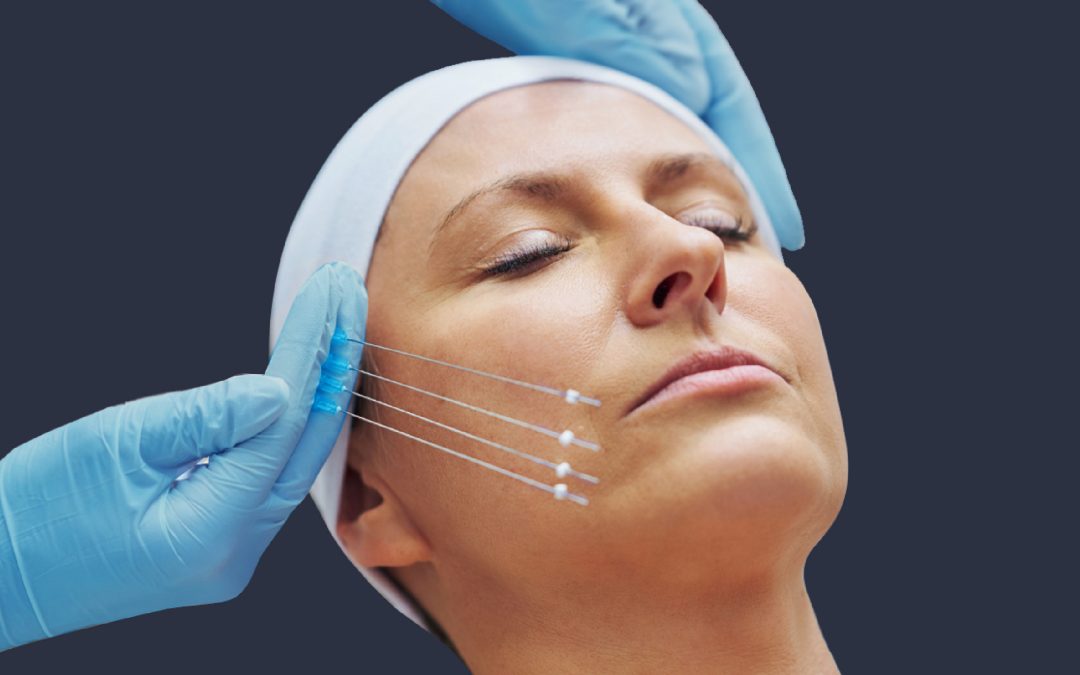 Tratamiento de hilos tensores en clínica estética de Santander y Valladolid, logrando lifting facial natural y reafirmando el rostro.